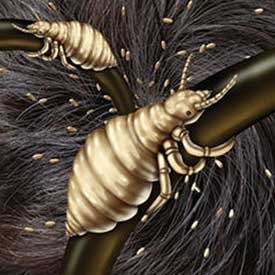 Cartoon of lice on hair