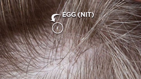 Lice egg on a piece of hair